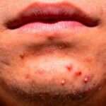 melhores pomadas para acne