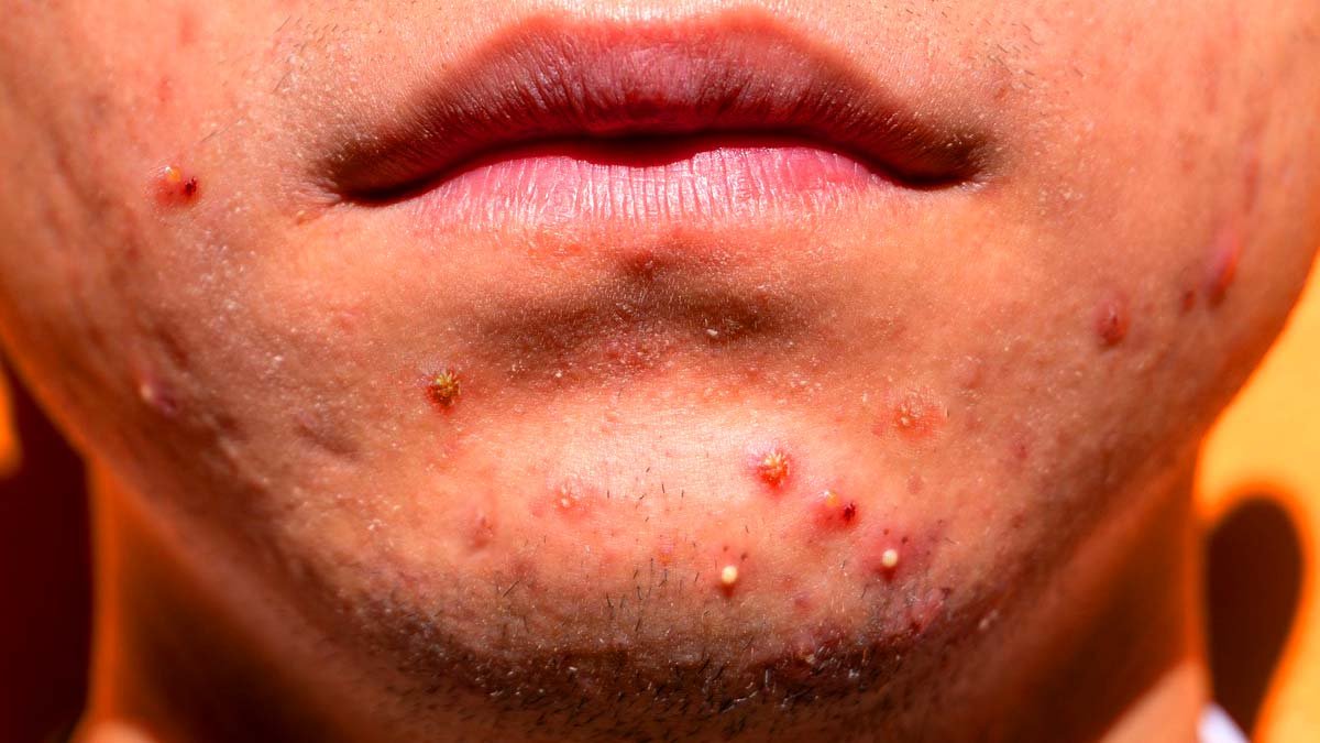 melhores pomadas para acne